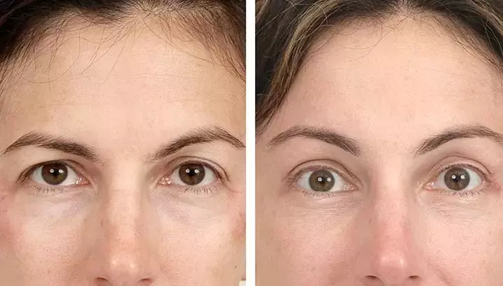 Radio Frequency Skin Tightening: A Non-Invasive Path to Firmer Skin
