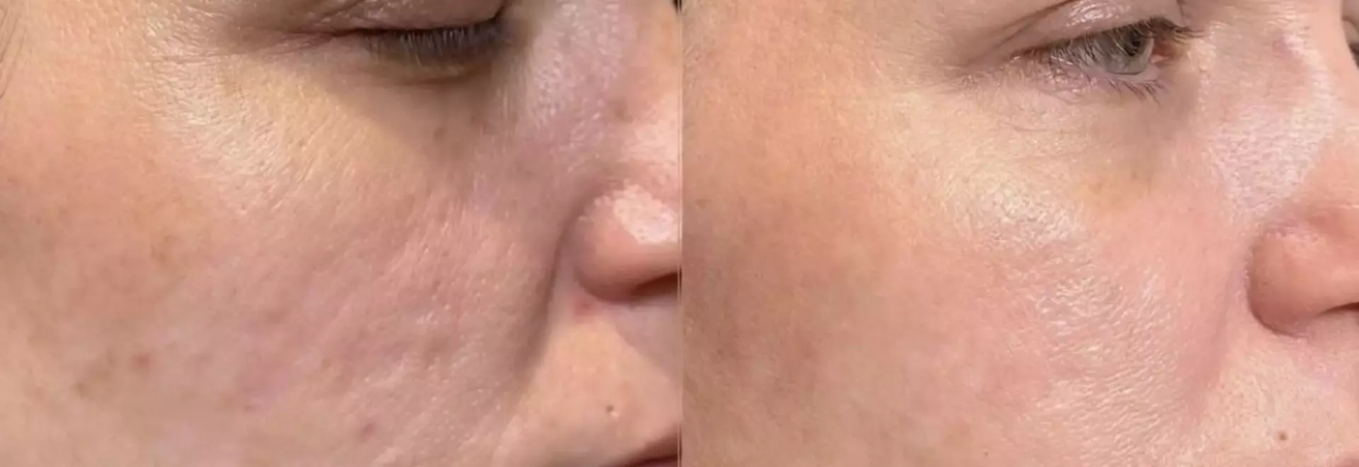 A Comprehensive Guide to Dermal Fillers: Types, Safety, Costs, and Savings