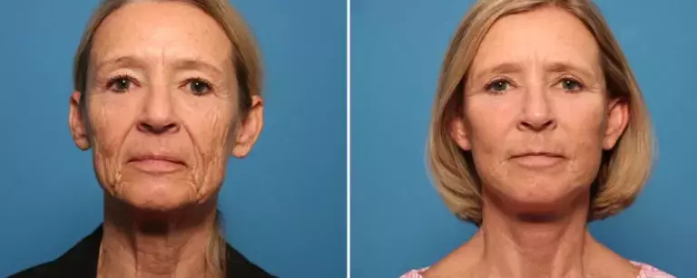 Ensayos de Lifting Facial: Una vía de bajo costo hacia técnicas de rejuvenecimiento de vanguardia