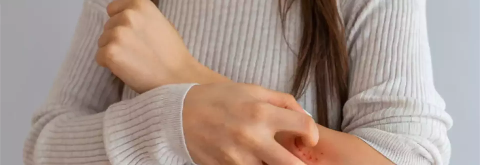 Gestione della Psoriasi: L'Importanza Cruciale dell'Alimentazione e degli Integratori