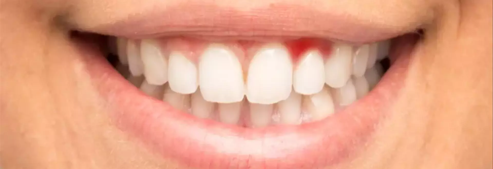 Gengive Sanguinanti e Carenza di Vitamina C: Un Legame Cruciale