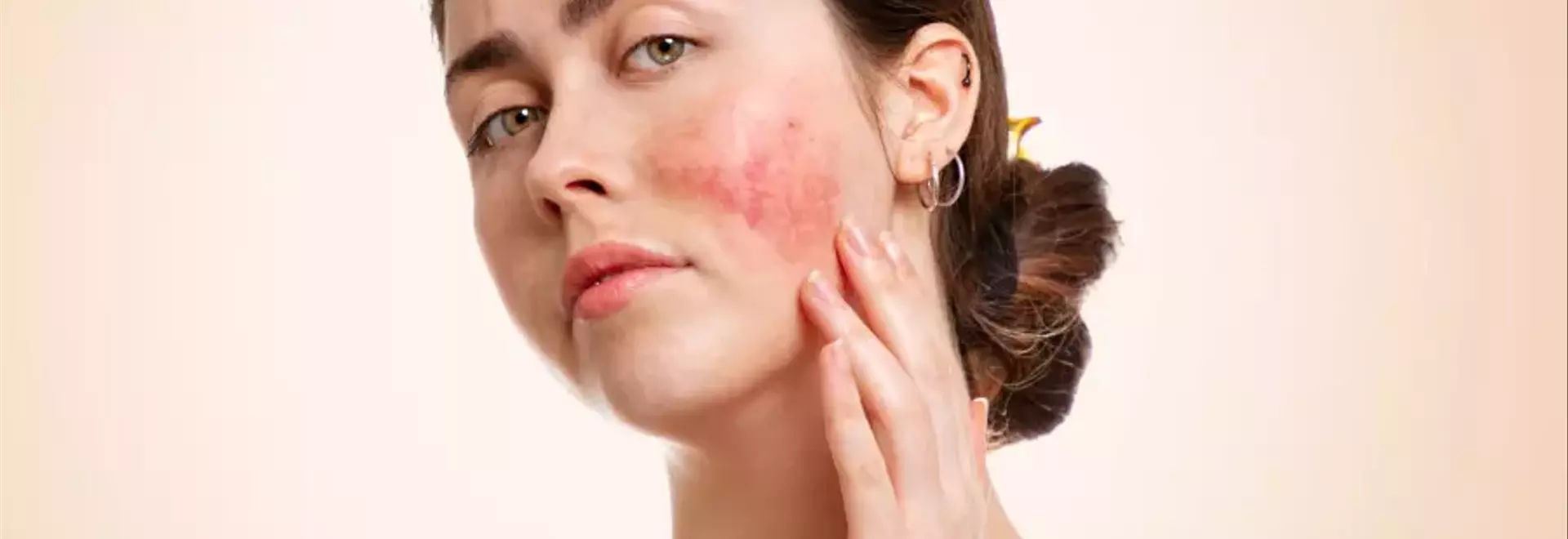 Gestione della Couperose: Approcci Naturali e Terapie Mediche per una Pelle Sana