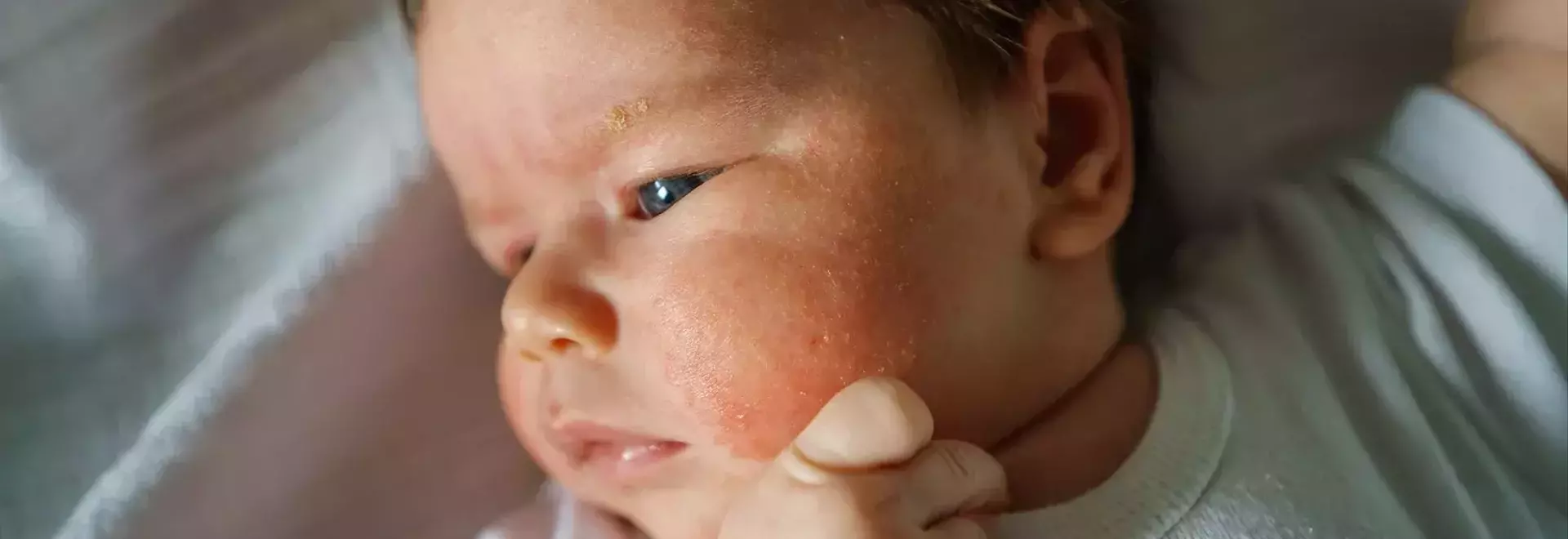 Common Rashes in Children: Identification and Management