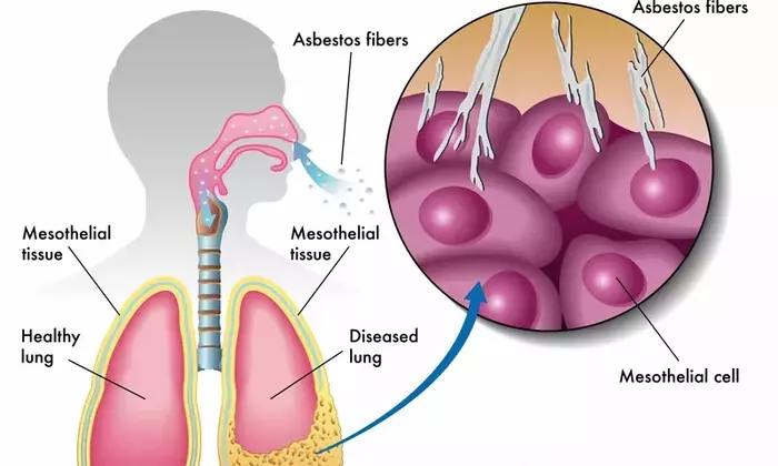Understanding Mesothelioma: A Comprehensive Scientific Overview