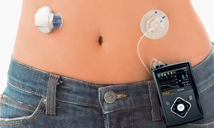 Insulin Pumps: A Comprehensive Guide to Understanding Continuous Insulin Delivery Systems