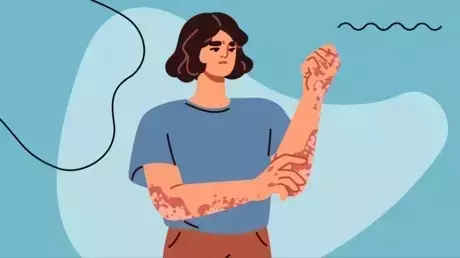 Understanding Eczema Treatment: A Comprehensive Scientific Overview