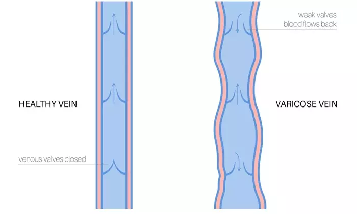 Understanding Varicose Vein Treatment: A Scientific and Technical Overview