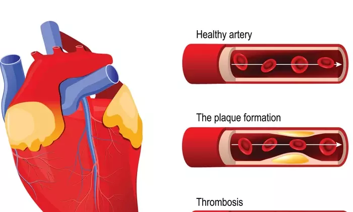 Understanding Coronary Heart Disease Treatment: A Comprehensive Clinical Overview