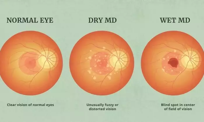 Understanding Macular Degeneration Treatment: A Comprehensive Clinical Overview