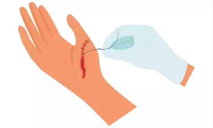 Understanding Scar Revision and Repair: A Comprehensive Scientific Overview