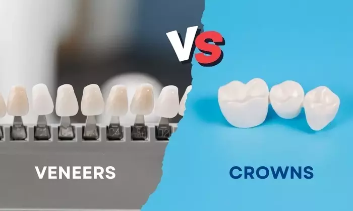 Understanding Tooth Whitening: A Comprehensive Scientific Overview