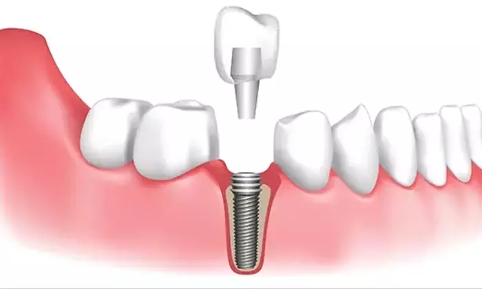 Dental Implants: A Scientific and Technical Perspective on Tooth Replacement