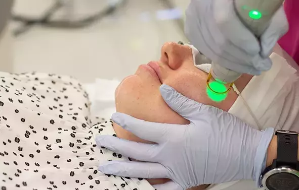 Laser Pigmentation Removal for Dark Skin: What to Know